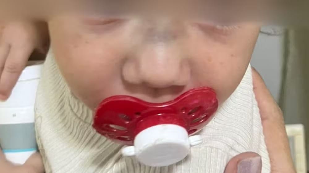 Bebê de 1 ano sofre fratura no nariz e hematomas após dia em creche de Valentim Gentil