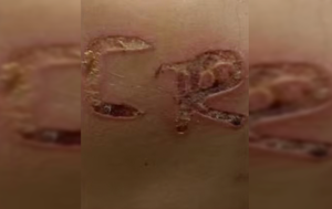 Homem é preso em Cosmorama por torturar esposa e marcar iniciais no corpo com ferro quente