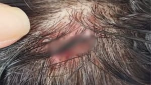 Homem é preso após morder e arrancar parte do dedo de vizinha em Auriflama